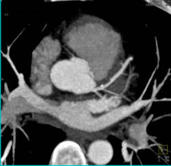 Plaque in LAD - CTisus CT Scan