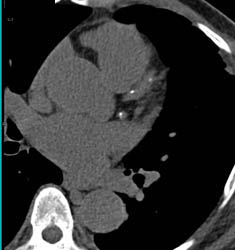 Plaque in LAD - CTisus CT Scan