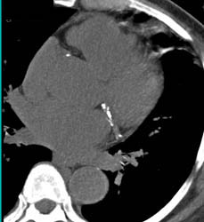 Calcified Plaque in All Vessels - CTisus CT Scan