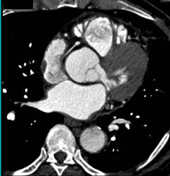 Nice View of Sa Nodal Branches Off RCA - CTisus CT Scan