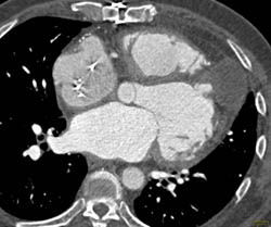 Enlarged Lv With Prior Infarct and Poor Wall Motion - CTisus CT Scan