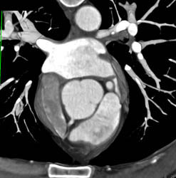 Normal Aortic Valve - CTisus CT Scan