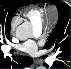 LAD Plaque Seen With MIP Imaging - CTisus CT Scan