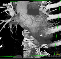 Nodal Branch Arises Directly Off Right Cusp - CTisus CT Scan