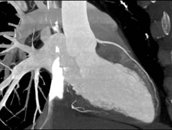 Normal LAD - CTisus CT Scan