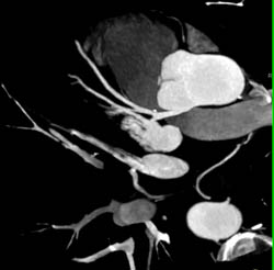 Small Plaque Without Stenosis LAD - CTisus CT Scan