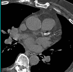 Extensive Plaque in Coronary Arteries - CTisus CT Scan