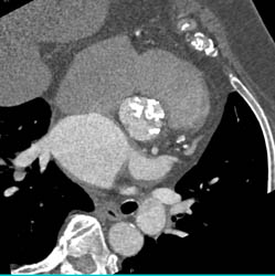 Extensive Aortic Valve Calcification With Aortic Stenosis - CTisus CT Scan