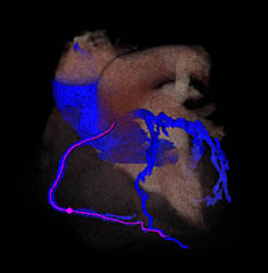 RCA Plaque With Vessel Tracking - CTisus CT Scan