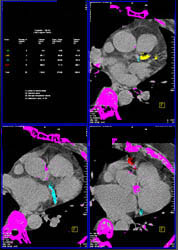 High Agatston Score - CTisus CT Scan