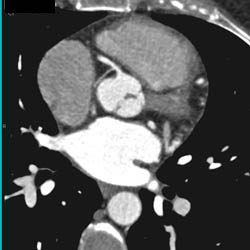 Sa Nodal Branch Off RCA - CTisus CT Scan