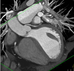 LAD Disease - CTisus CT Scan