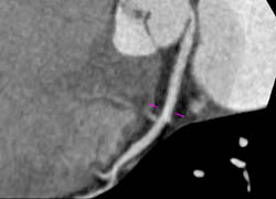 LAD Disease - CTisus CT Scan