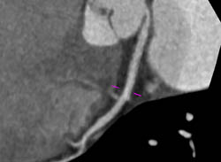 LAD Disease - CTisus CT Scan