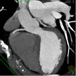 LAD Disease - CTisus CT Scan