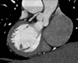 LAD Disease - CTisus CT Scan