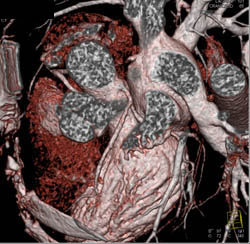 Coronary Artery Anatomy for LAD in Various Renderings - CTisus CT Scan