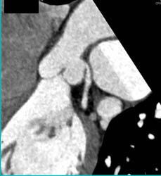 Narrowing of Origin of Left Main Coronary Artery Only Seen in Correct Perspective - CTisus CT Scan