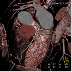 Trifurcation of Left Main Coronary Artery - CTisus CT Scan