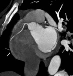 RCA Branching - CTisus CT Scan