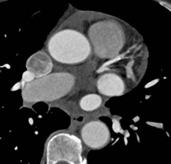 Plaque in LAD With Around 50% Stenosis - CTisus CT Scan