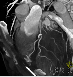 Calcified Plaque LAD in Various Perspectives - CTisus CT Scan