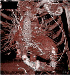 Left Internal Mammary Artery (LIMA) Graft and Venous Grafts - CTisus CT Scan