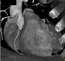 Normal Coronary Artery Anatomy - CTisus CT Scan