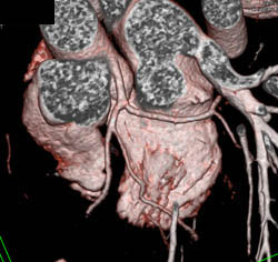 Left Main Into LAD and Circumflex - CTisus CT Scan