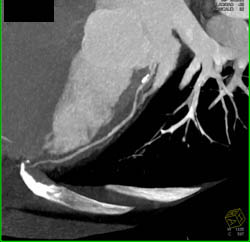 Plaque in LAD - CTisus CT Scan