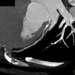 Plaque in LAD - CTisus CT Scan