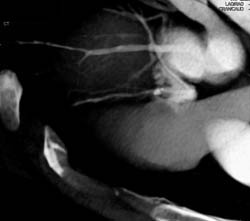 Plaque in LAD - CTisus CT Scan