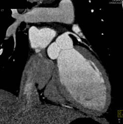 Plaque in LAD - CTisus CT Scan