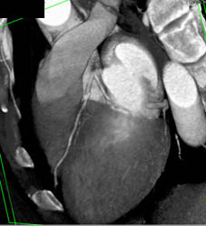 Plaque in LAD - CTisus CT Scan