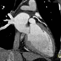 Plaque in LAD - CTisus CT Scan