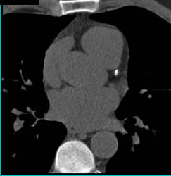 Plaque in LAD - CTisus CT Scan