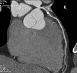 Plaque in LAD - CTisus CT Scan