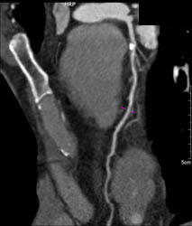 Plaque in LAD - CTisus CT Scan