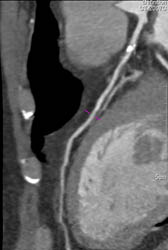 Plaque in LAD - CTisus CT Scan