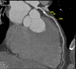 Plaque in LAD - CTisus CT Scan