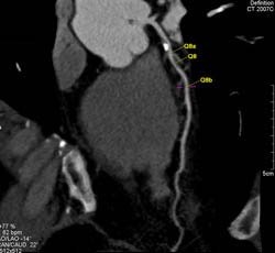 Plaque in LAD - CTisus CT Scan