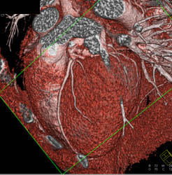 Normal LAD - CTisus CT Scan