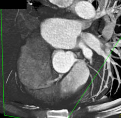 Normal RCA - CTisus CT Scan