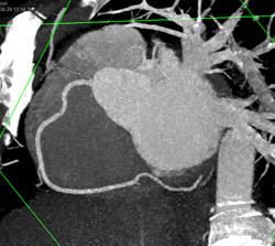 Normal RCA - CTisus CT Scan