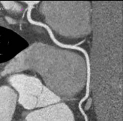 Normal RCA - CTisus CT Scan