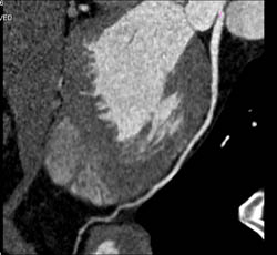 Normal RCA - CTisus CT Scan