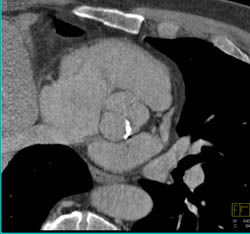 Calcified Aortic Valve - CTisus CT Scan