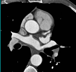 Plaque LAD - CTisus CT Scan