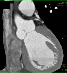 Plaque LAD - CTisus CT Scan