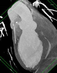 Plaque LAD - CTisus CT Scan